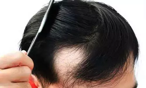 Baldness: చిన్న ఏజ్‌లోనే బట్టతల రావడానికి కారణాలు..నిపుణులు ఏం చెబుతున్నారంటే?