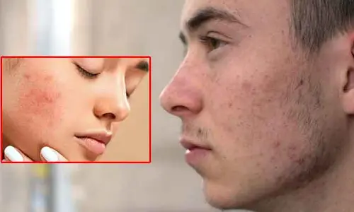 Sex & Science : హస్తప్రయోగం చేస్తే మొటిమలు వస్తాయా ?