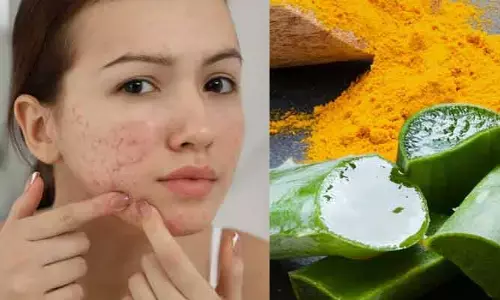Summer Tips : వేసవిలో మొటిమలు వేధిస్తున్నాయా? ఇలా చేస్తే ఈజీగా తగ్గుతాయంటున్న నిపుణులు