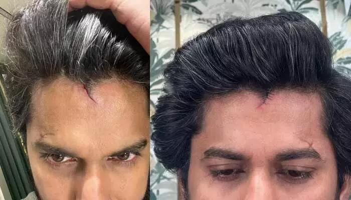 తల పగిలి కుట్లు పడ్డా కూడా షూటింగ్లో పాల్గొన్న స్టార్ హీరో.. నీ డెడికేషన్కు టేక్ ఎ బౌ అంటూ ఫ్యాన్స్ కామెంట్స్(పోస్ట్) తల పగిలి కుట్లు పడ్డా కూడా షూటింగ్లో పాల్గొన్న స్టార్ హీరో.. నీ డెడికేషన్కు టేక్ ఎ బౌ అంటూ ఫ్యాన్స్ కామెంట్స్(పోస్ట్)