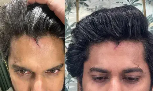 తల పగిలి కుట్లు పడ్డా కూడా షూటింగ్‌లో పాల్గొన్న స్టార్ హీరో.. నీ డెడికేషన్‌కు టేక్ ఎ బౌ అంటూ ఫ్యాన్స్ కామెంట్స్(పోస్ట్)