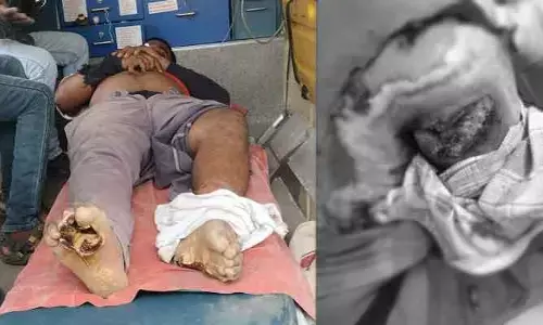 విద్యుత్ షాక్ కి గురైన లైన్మెన్.. తీవ్ర గాయాలు