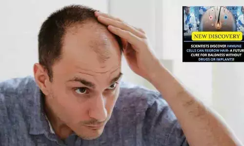 Baldness : బట్టతలకు ఇక శాశ్వత పరిష్కారం.. ఔషధ, చికిత్స రహిత పరిష్కారాన్ని కనుగొన్న శాస్త్రవేత్తలు..!