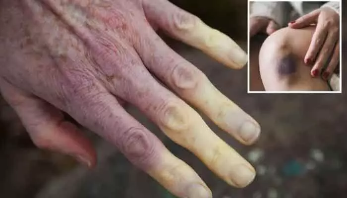 Health : చర్మం తరచుగా రంగులు మారుతోందా.. ? మీ గుండె రిస్క్లో ఉండొచ్చు..! Health : చర్మం తరచుగా రంగులు మారుతోందా.. ? మీ గుండె రిస్క్లో ఉండొచ్చు..!