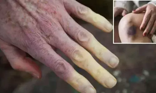 Health : చర్మం తరచుగా రంగులు మారుతోందా.. ? మీ గుండె రిస్క్‌లో ఉండొచ్చు..!