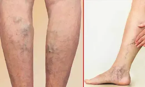 Health : కాళ్లపై ఉబ్బిన నరాలు.. బలం కాదు.. వెరికోస్ వీన్స్ సమస్య !