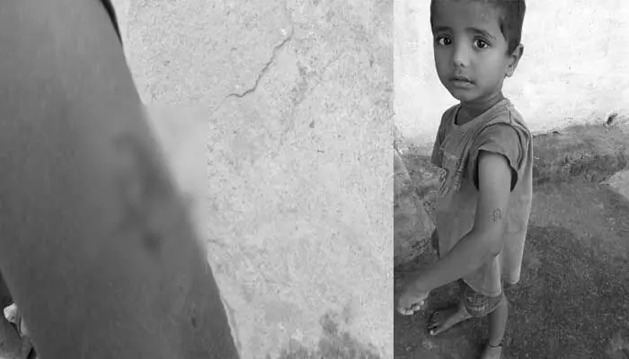 వీధి కుక్క కాటు.. భ‌యాందోళ‌నలో ప్ర‌జ‌లు