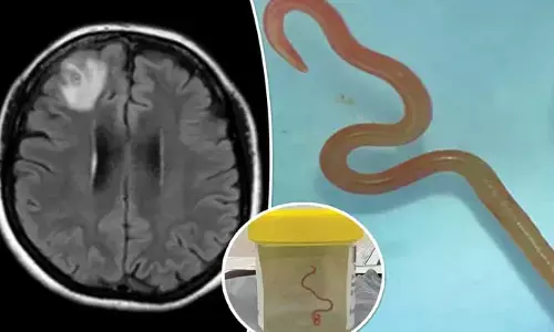 వైద్యులు షాక్.. మహిళ మెదడులో ఆస్కారిస్ పురుగు