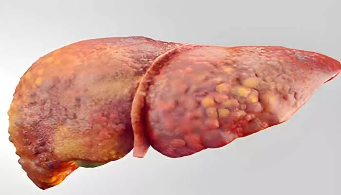 Fatty Liver : మద్యం సేవించకపోయినా ఫ్యాటీ లివర్ సమస్య వస్తుంది.. ఎందుకో తెలుసా..? Fatty Liver : మద్యం సేవించకపోయినా ఫ్యాటీ లివర్ సమస్య వస్తుంది.. ఎందుకో తెలుసా..?