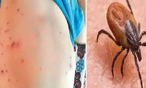 ఏపీలో స్క్రబ్ టైఫస్ కలకలం.. ఆరేళ్ల బాలికకు పాజిటివ్