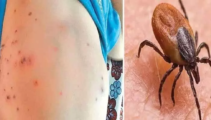ఏపీలో స్క్రబ్ టైఫస్ కలకలం.. ఆరేళ్ల బాలికకు పాజిటివ్ ఏపీలో స్క్రబ్ టైఫస్ కలకలం.. ఆరేళ్ల బాలికకు పాజిటివ్