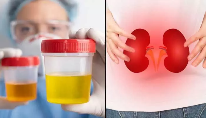 Health : యూరిన్ రంగు మారుతోందా..? కిడ్నీలు డేంజర్లో ఉన్నట్టే ! Health : యూరిన్ రంగు మారుతోందా..? కిడ్నీలు డేంజర్లో ఉన్నట్టే !