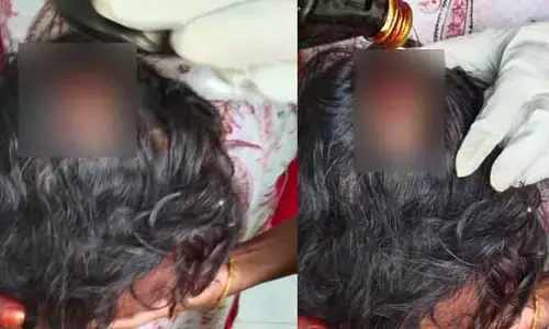 ఐదేళ్ల బాలికపై కోతుల దాడి.. తీవ్ర గాయాలు