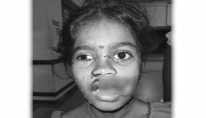 వీధి కుక్కల దాడి..ఐదేళ్ల‌ బాలికకు తీవ్రమైన  గాయాలు