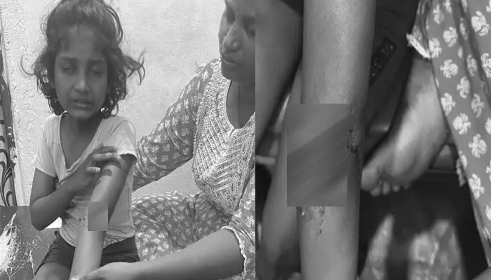 వీధి కుక్కల దాడిలో బాలికకు గాయాలు