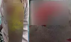 వీధి కుక్క దాడిలో ఇద్దరు చిన్నారులకు గాయాలు