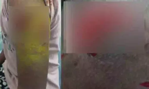 వీధి కుక్క దాడిలో ఇద్దరు చిన్నారులకు గాయాలు