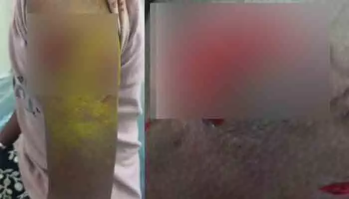 వీధి కుక్క దాడిలో ఇద్దరు చిన్నారులకు గాయాలు వీధి కుక్క దాడిలో ఇద్దరు చిన్నారులకు గాయాలు