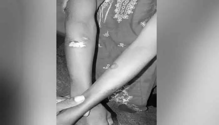 తెలంగాణా సరిహద్దులో దారుణం..దొంగతనం ఒప్పుకోమని...బాలిక చేతులపై వాతలు తెలంగాణా సరిహద్దులో దారుణం..దొంగతనం ఒప్పుకోమని...బాలిక చేతులపై వాతలు