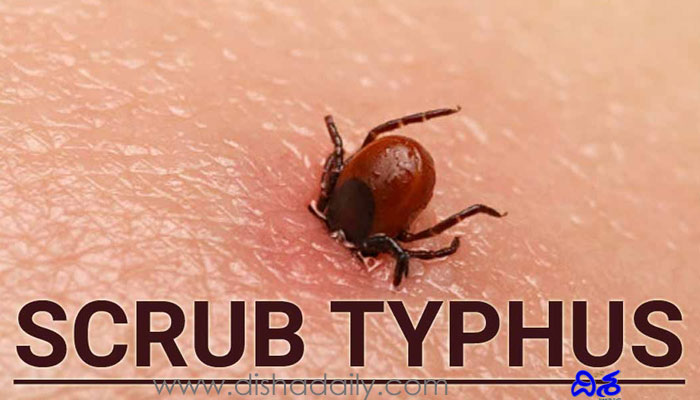 Scrub Typhus :భయపెడుతున్న కొత్త జ్వరం.. ఇప్పటికే 100 మంది బలి